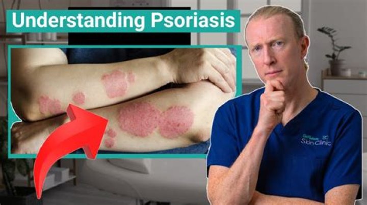 Could my psoriasis actually be ringworm?