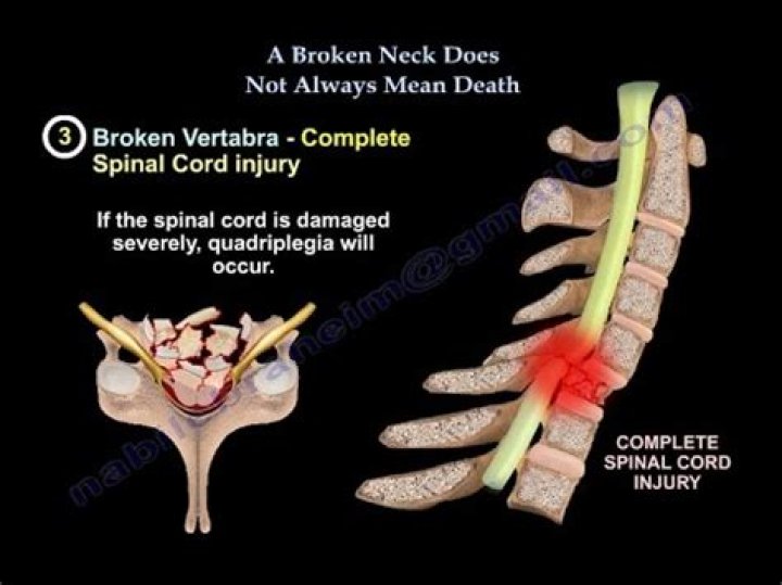 Could you die from a broken spine?