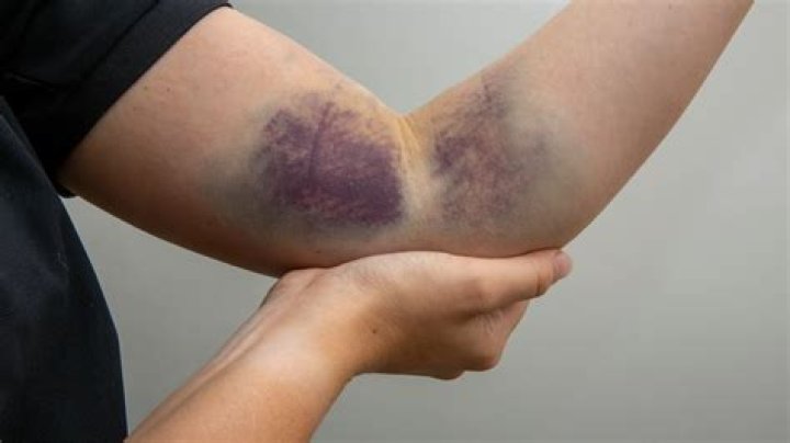 Did i bruise or break my heel?