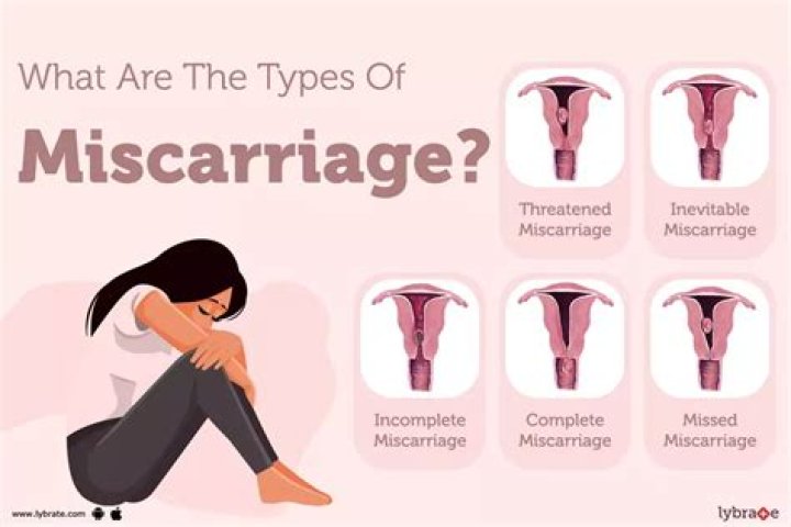 Did i miscarry because i'm overweight?