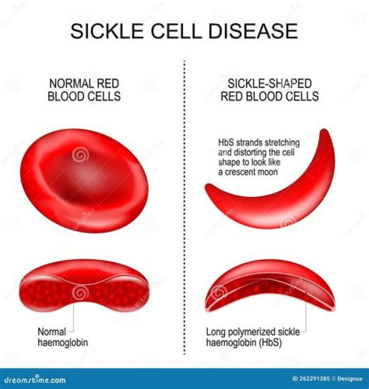 Did left eye have sickle cell?