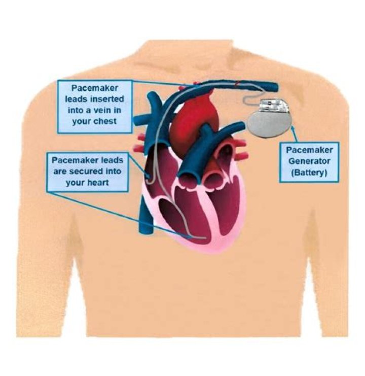 Did the others put a pacemaker in sawyer?