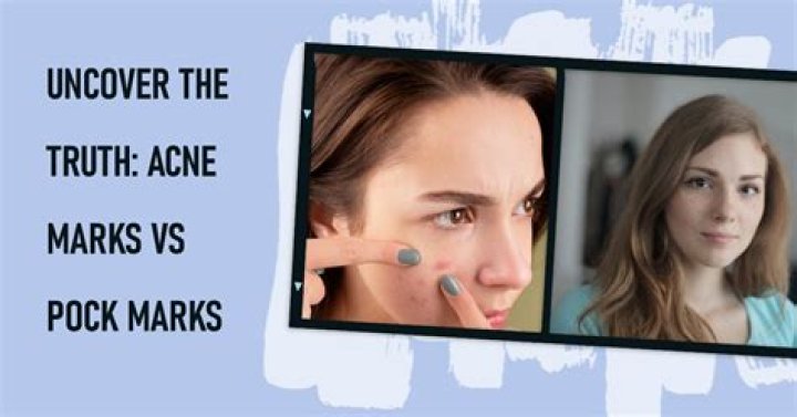 Do acne pock marks go away?