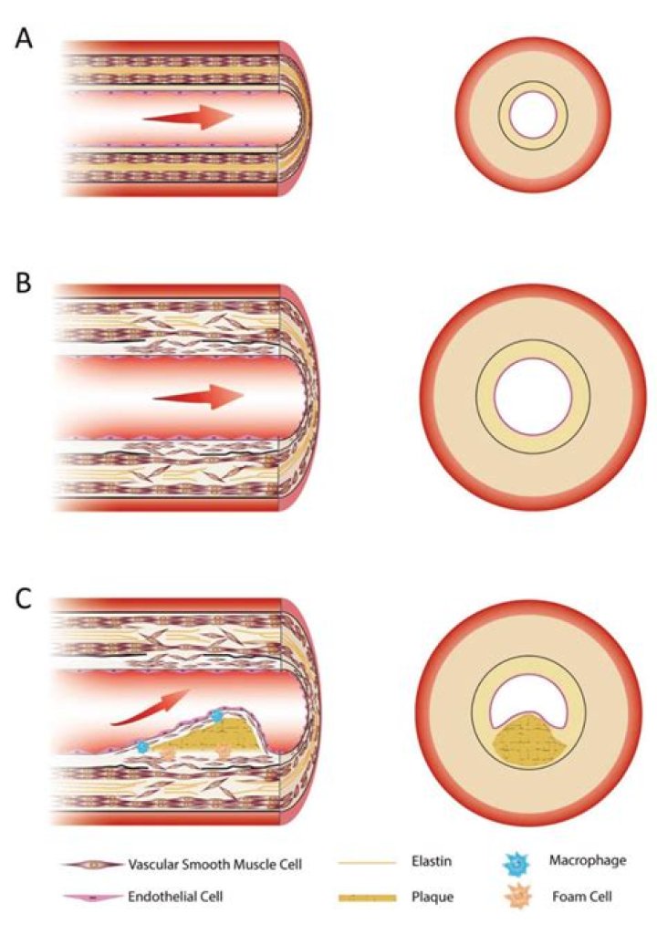 Do artery walls heal?