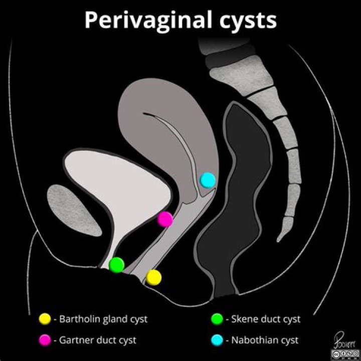 Do bartholin cysts pop?