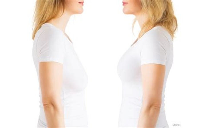 Do breast lifts last?