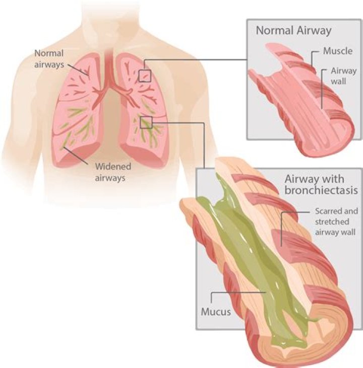 Do bronchial spasms go away?