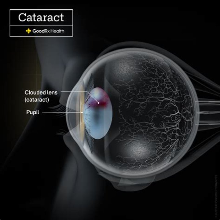 Do cataracts cause scratchy eyes?