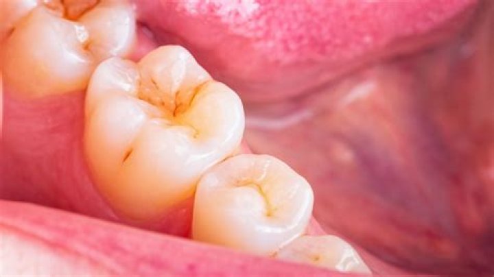 Do cavities cause pain?