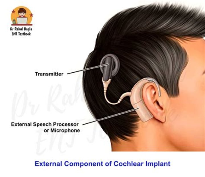 Do cochlear implants need to be replaced?