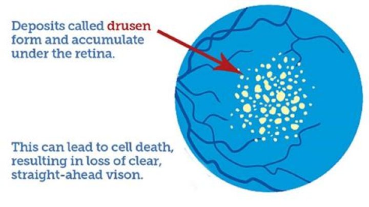 Do drusen always lead to macular degeneration?
