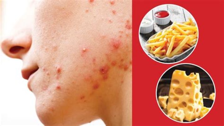 Do eating meat cause acne?