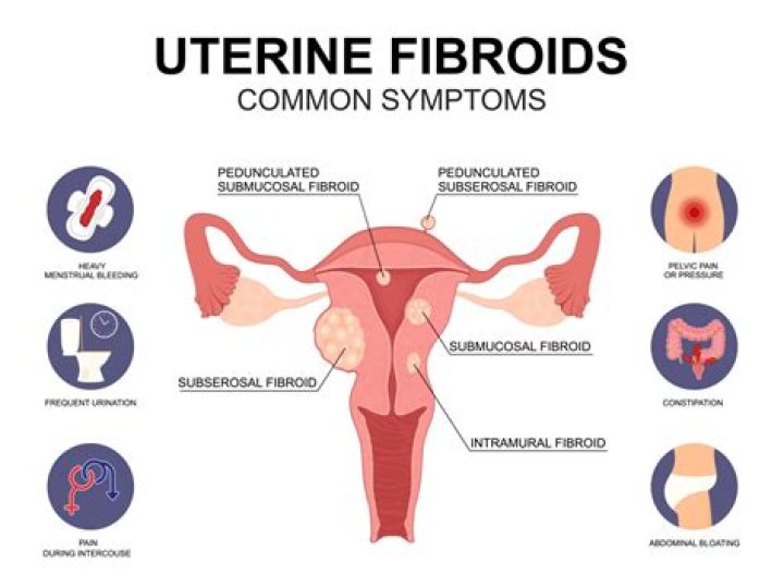 Do every woman have fibroid?