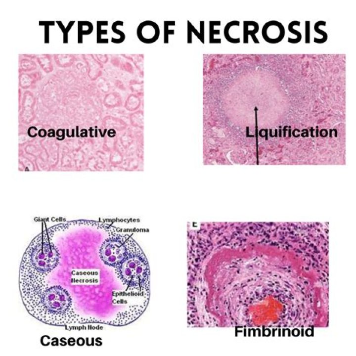 Do fibroids cause necrosis?