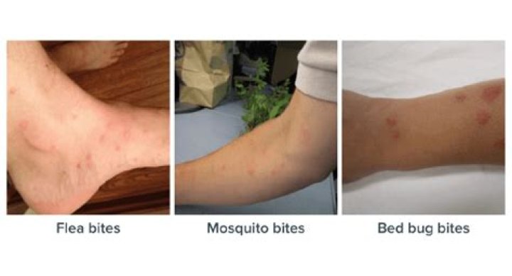 Do fleas bite human scalps?
