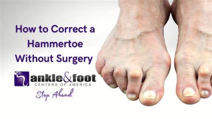 Do hammertoes require surgery?