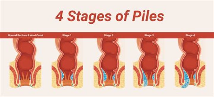 Do hemorrhoids flare up?