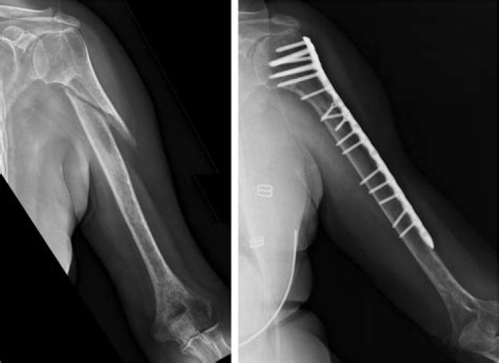Do humerus fracture need surgery?