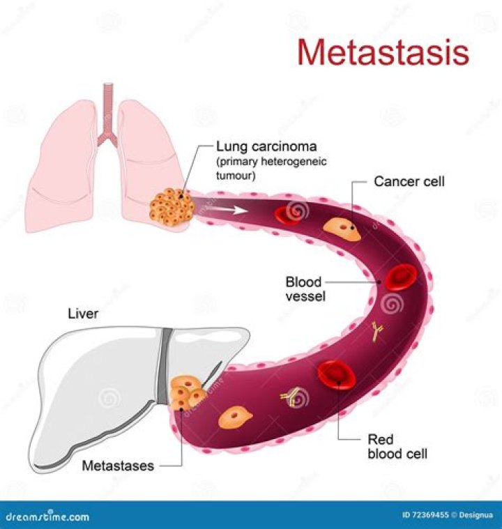 Do i have metastasis?