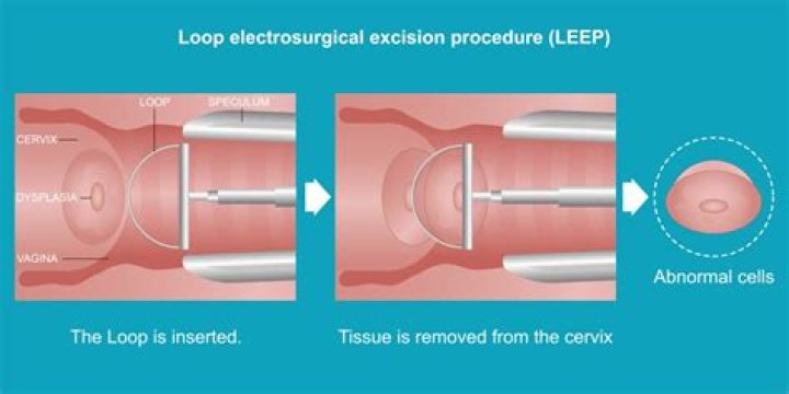 Do i really need a leep procedure?