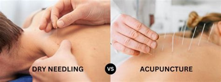 Do i undress for acupuncture?