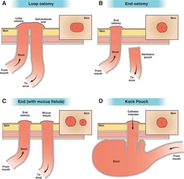 Do ileostomies make noise?