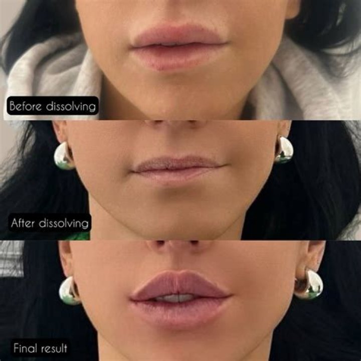 Do lips swell after dissolving?