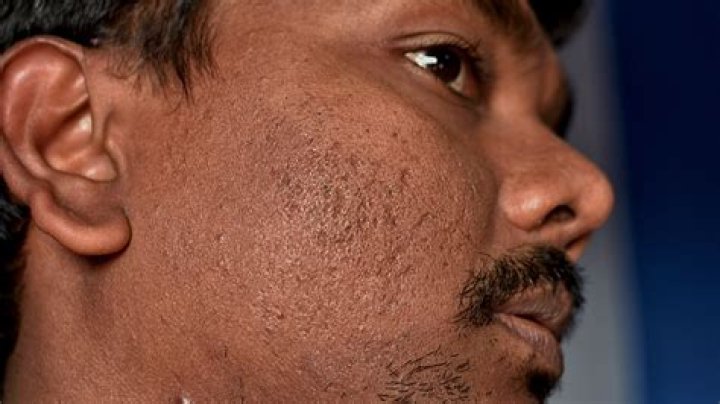 Do pockmarks get worse with age?