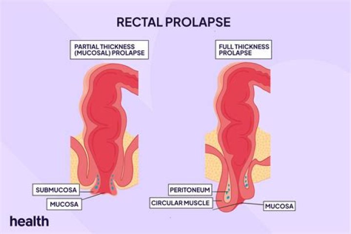 Do prolapse get worse?