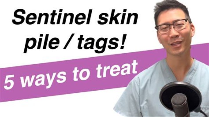 Do sentinel skin tags hurt?