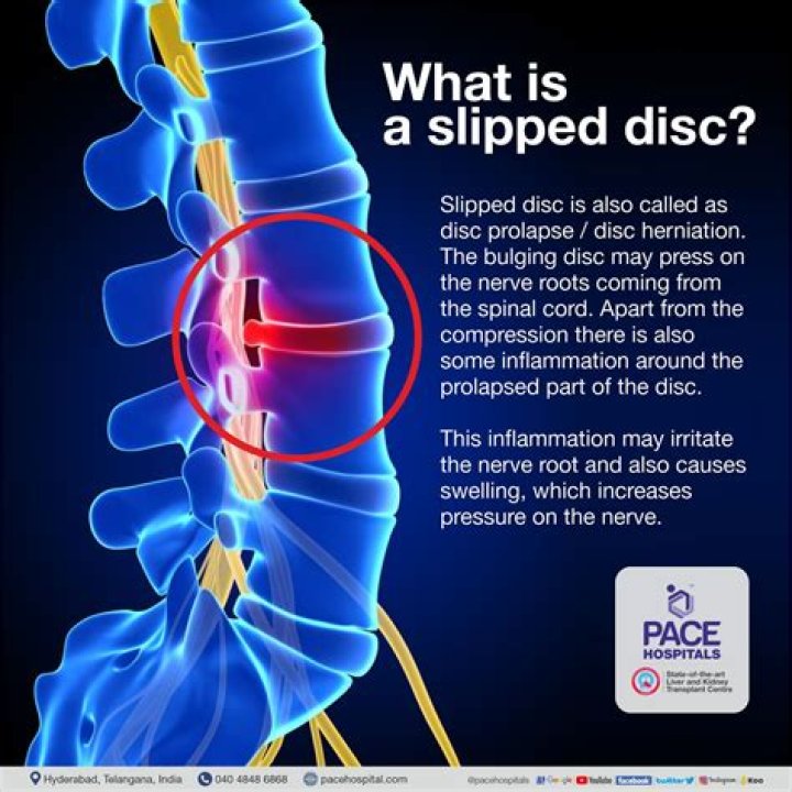 Do slipped discs go back in?