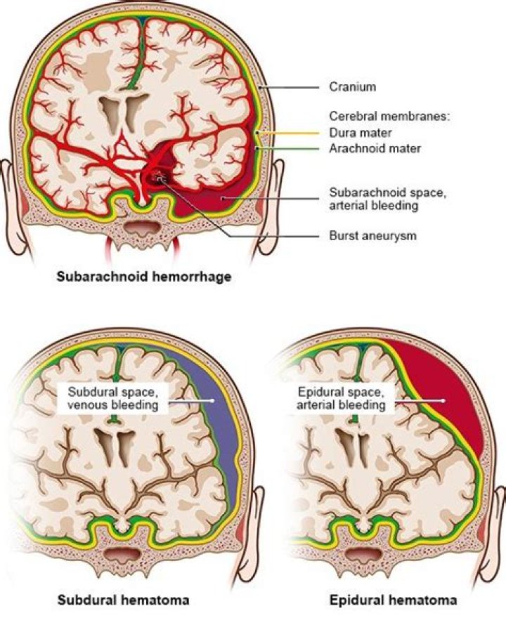 Do subdural hemorrhage go away?