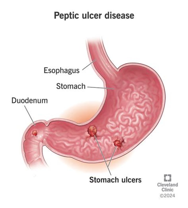 Do ulcers cause stomach rumbling?