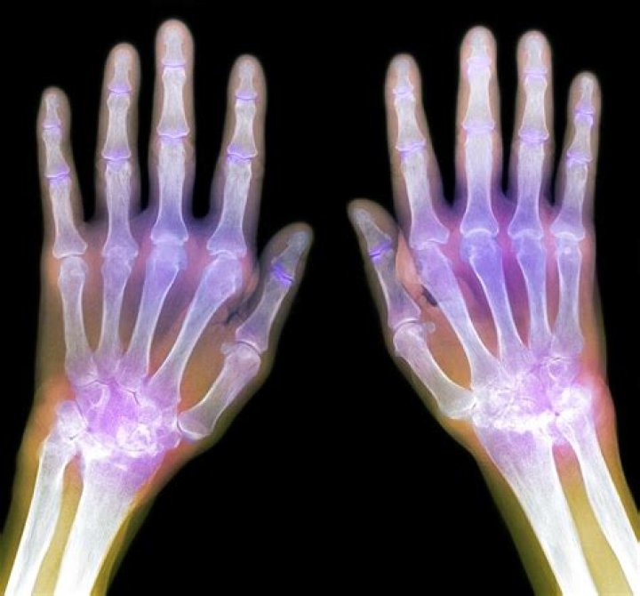 Do x rays show arthritis?