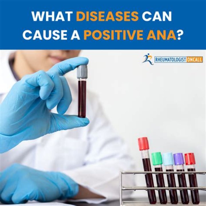 Do you have a positive ana with ms?