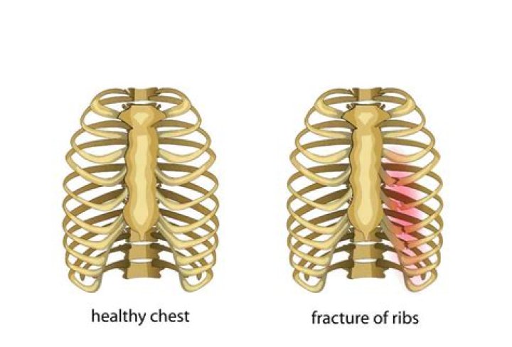 Do you wrap up broken ribs?