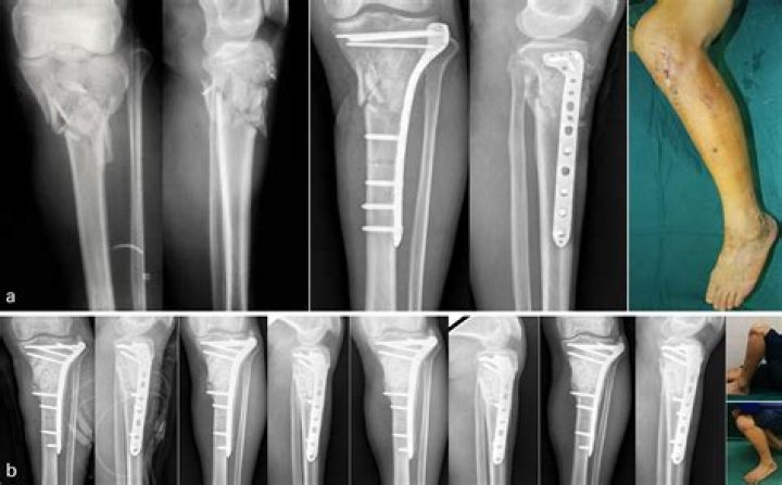 Does a broken tibia require surgery?