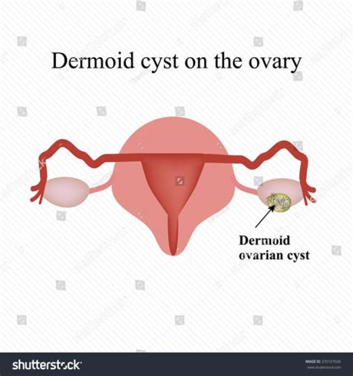 Does a dermoid cyst hurt?