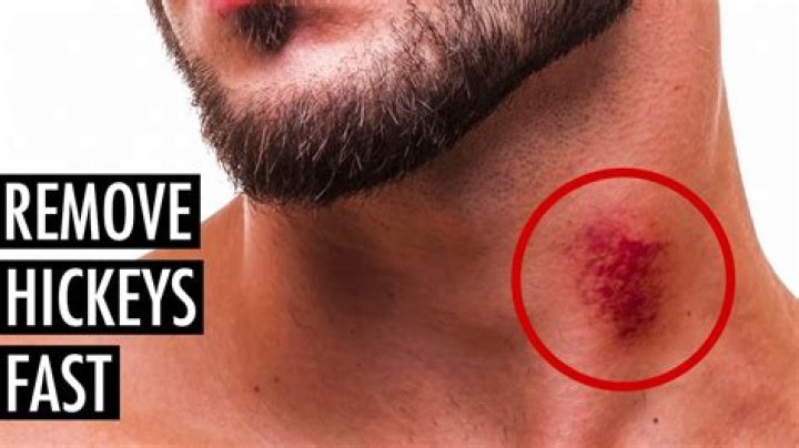Does a hickey hurt?