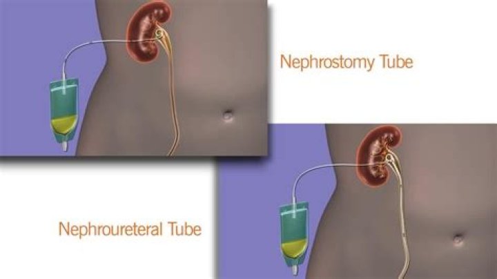 Does a nephrostomy tube hurt?