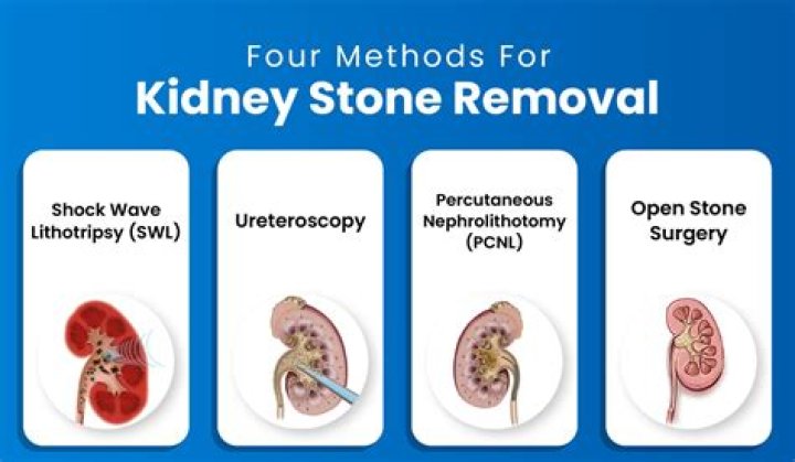 Does a stent help with kidney stones?