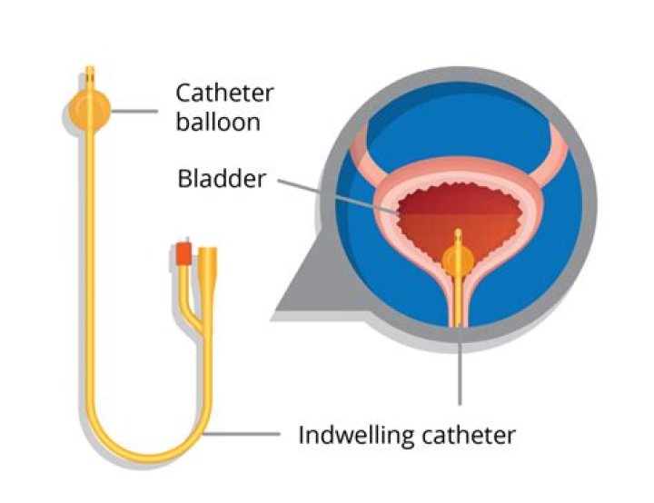 Does a urinary indwelling catheter treat incontinence?