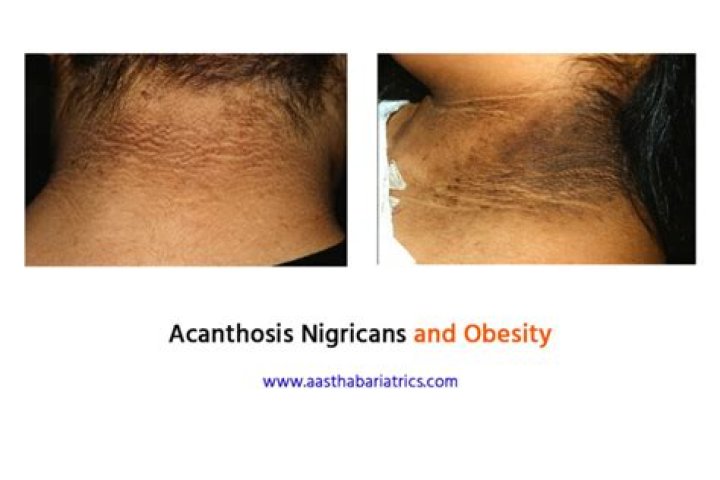 Does acanthosis nigricans always mean diabetes?
