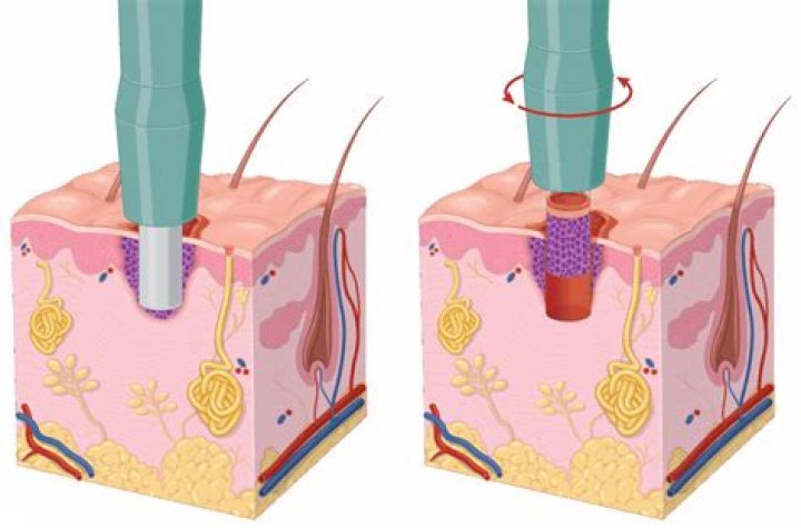 Does aetna cover keratoplasty?