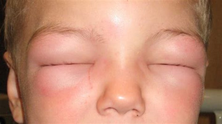 Does angioedema go away?