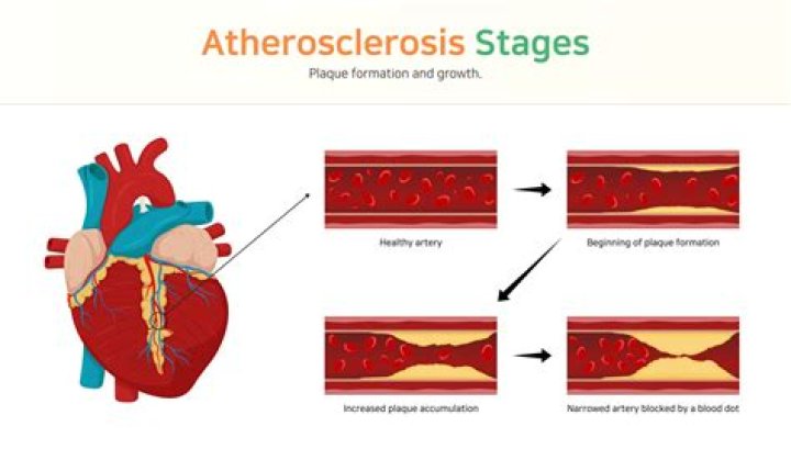 Does arteriosclerosis cause hypertension?