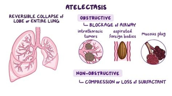 Does atelectasis cause fever?