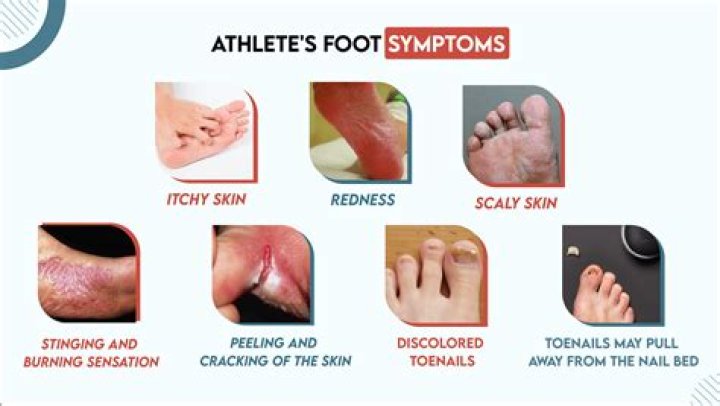 Does athlete's foot flare up?