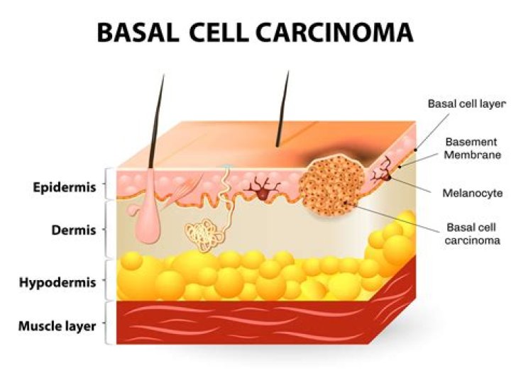 Does basal cell carcinoma metastasize?