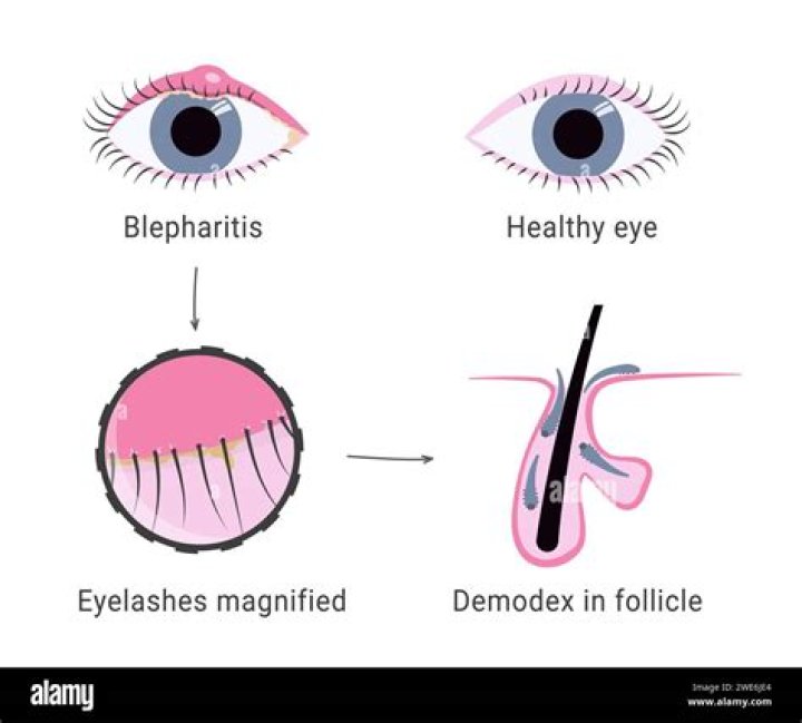 Does blepharitis make you tired?